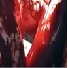 🩸